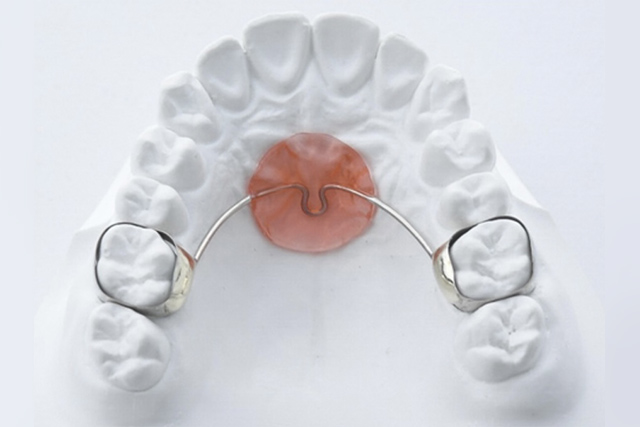 奥歯の固定式矯正装置